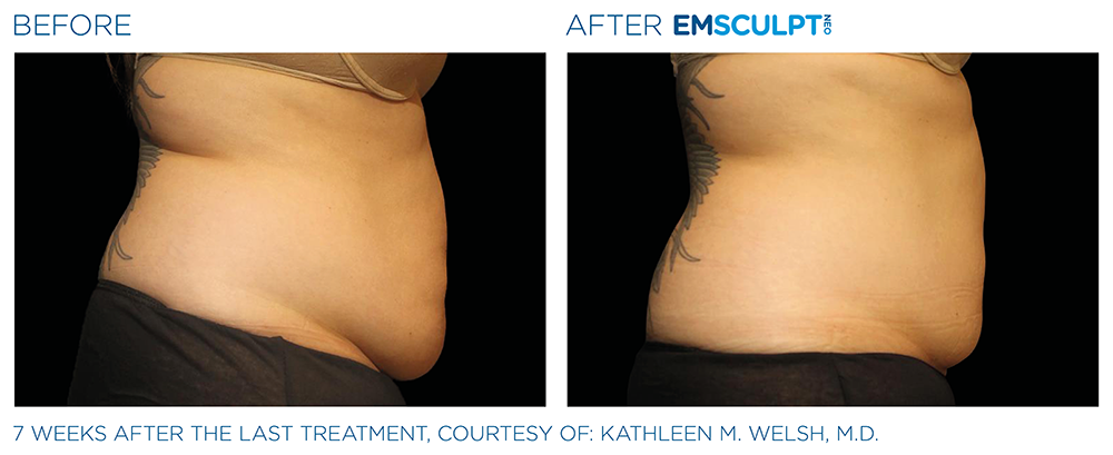 Abdomen (Lateral) before and after results