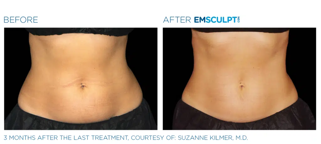 Abdomen before and after results