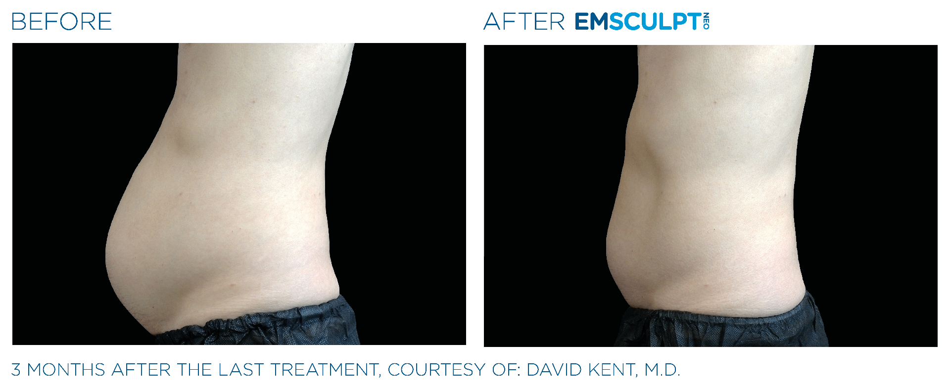 Abdomen (Lateral) before and after results
