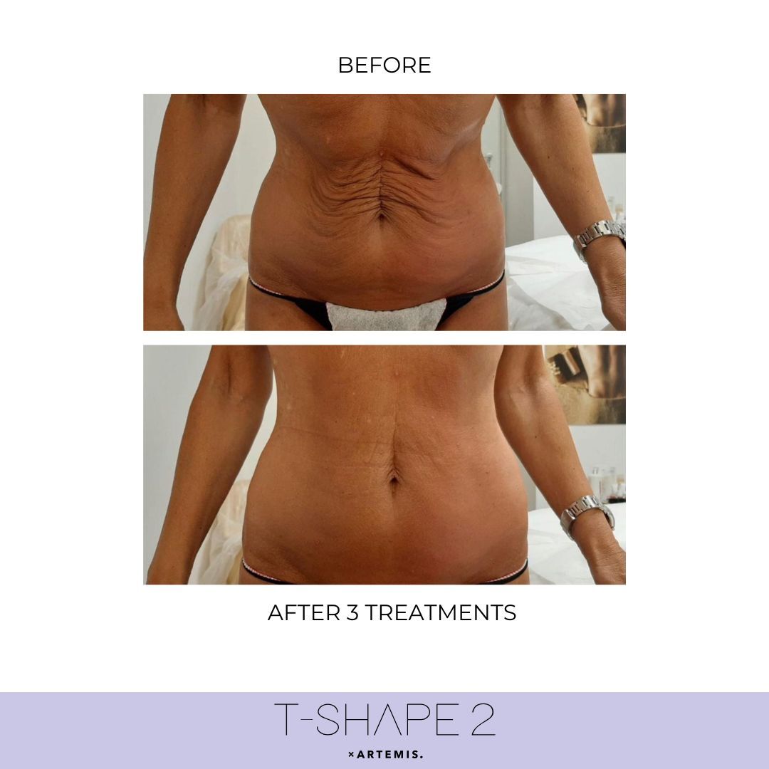 Abdomen before and after results