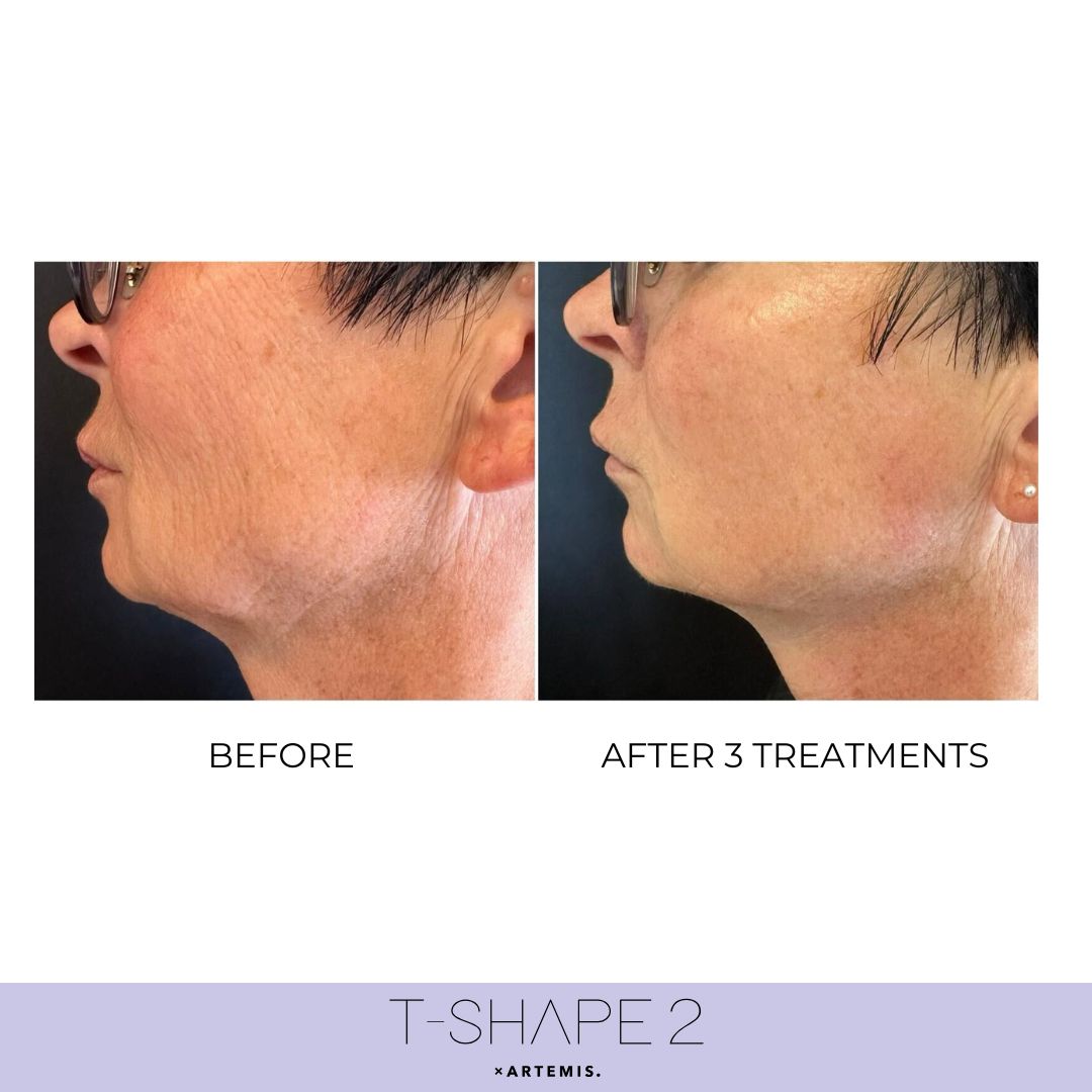 Neck before and after results