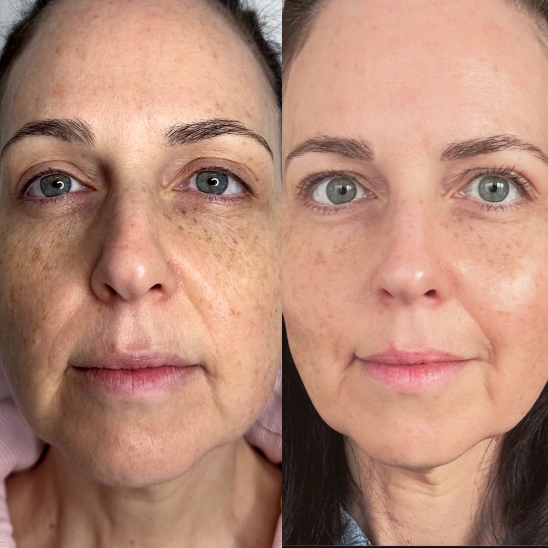 Neogen Face Lift treatment offer at iCRYO SouthPark